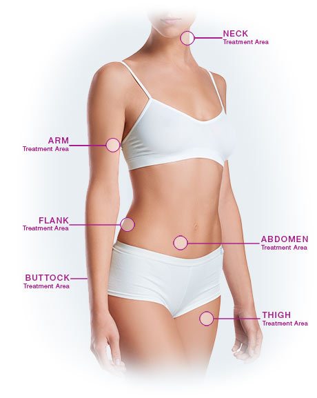 diagram shows treatment areas of the body for Velashape
