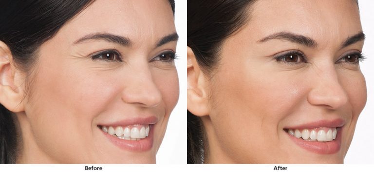 Before and after Botox treatment