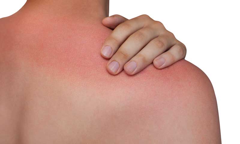 Signs of Sun Damage to Your Skin - How to It - Vibrance MedSpa