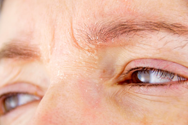 Closeup showing dry skin and wrinkles on person's face
