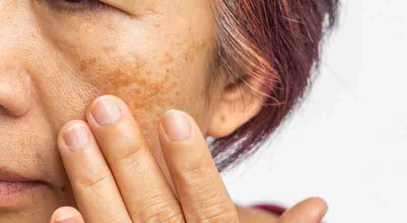 A woman is examining her face and touching her skin where there is melasma present