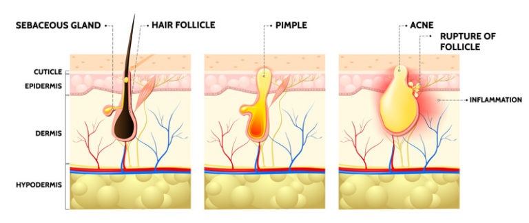 5 Habits to Prevent and Treat Acne for Flawless Skin - Vibrance MedSpa