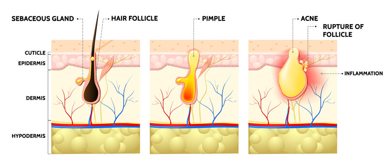 How acne is formed