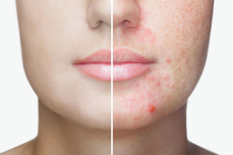 Woman's Face Half with acne and half without acn