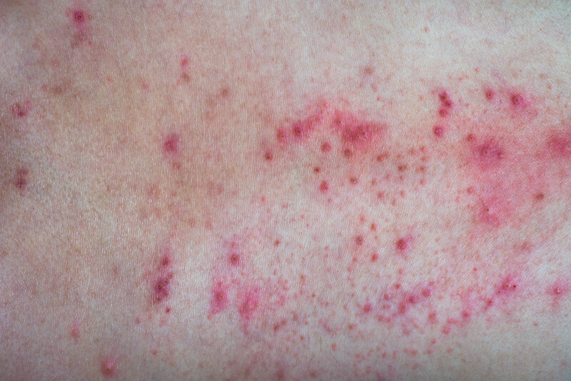 Example of Contact Dermatitis