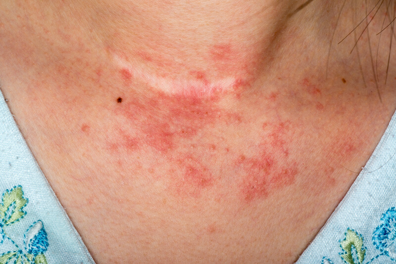 Eczema on woman's neck areas