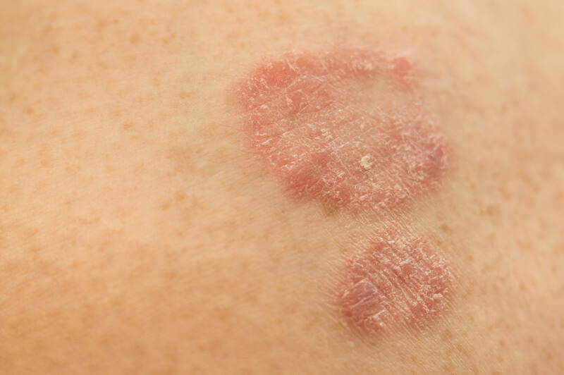 Sensitive Skin And Skin Allergies