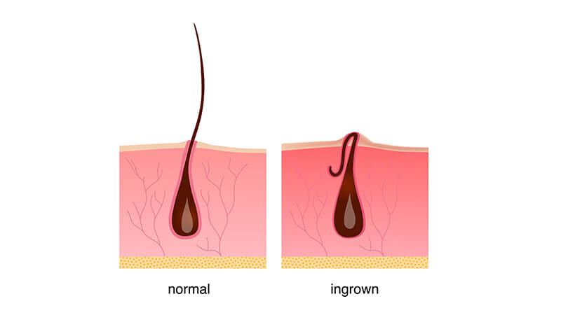 Why do multiple hairs grow out of one follicle