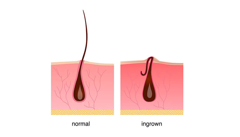 Using Laser Hair Removal To Eliminate Ingrown Hair Vibrance Medspa