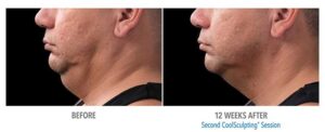 Before and 12 Weeks After CoolSculpting images of man with double chin