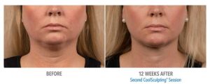 A Before and After CoolSculpting treatment for a double chin