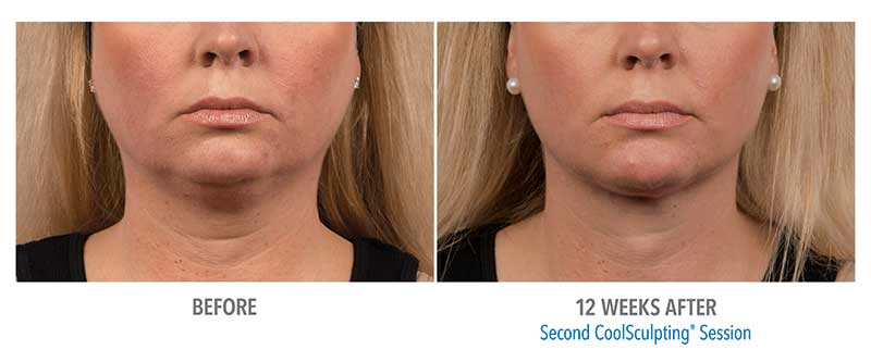 A Before and After CoolSculpting treatment for a double chin