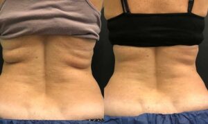 Before and after Coolsculpting treatment for love handles