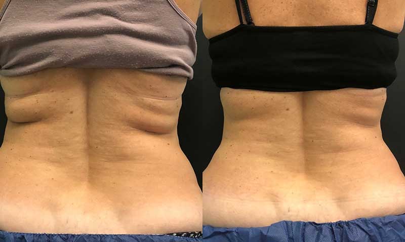 Before and after Coolsculpting treatment for love handles