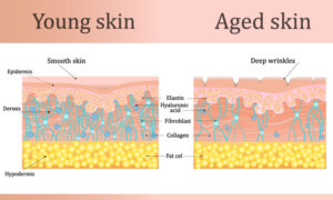 Graphic depicting the layers of young skin vs aged skin