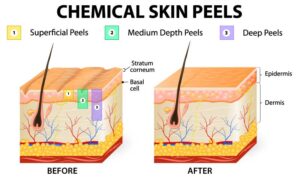 graphic depiction of layers of skin before and after chemical skin peels
