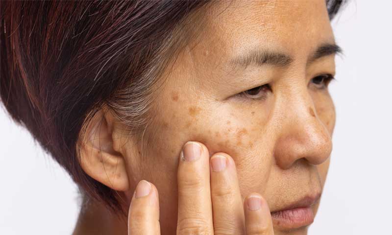 A woman with melasma touching her face
