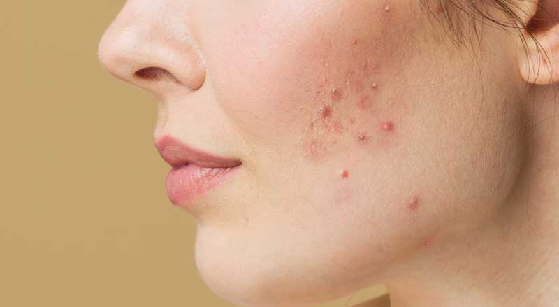 A woman with adult acne on her face