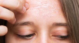A woman with sensitive, peeling skin on her forehead