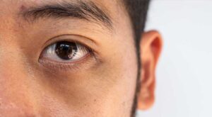 A close-up of a man’s eye with dark circles