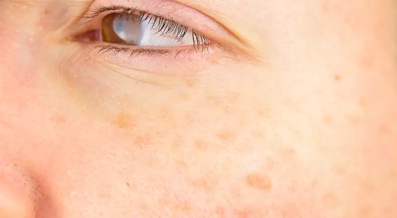 Closeup of one side of a woman’s face with dark spots
