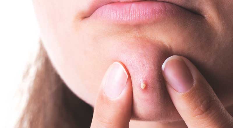 Young woman using her fingers to squeeze a pimple on her chin