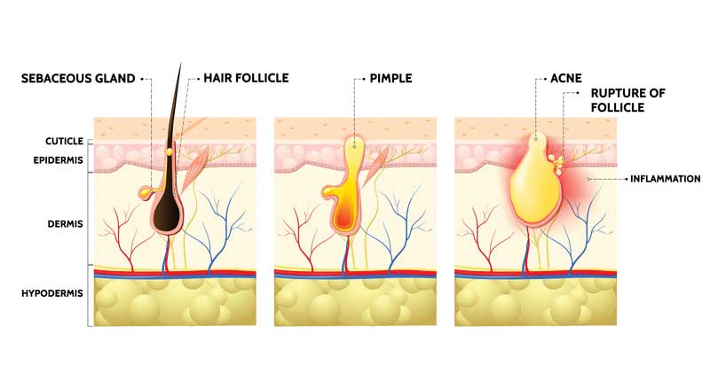 A drawing of how acne forms under skin near hair follicles